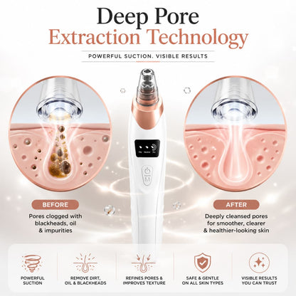 Electric Blackhead Remover – Pore Vacuum Suction Cleaner